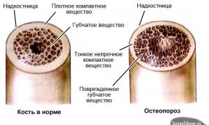 Остеопороз - сүйек тінінің бұзылуы, аурудың себептері, белгілері және емі
