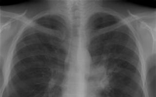 Рак легень та флюорографія: ознаки на знімку