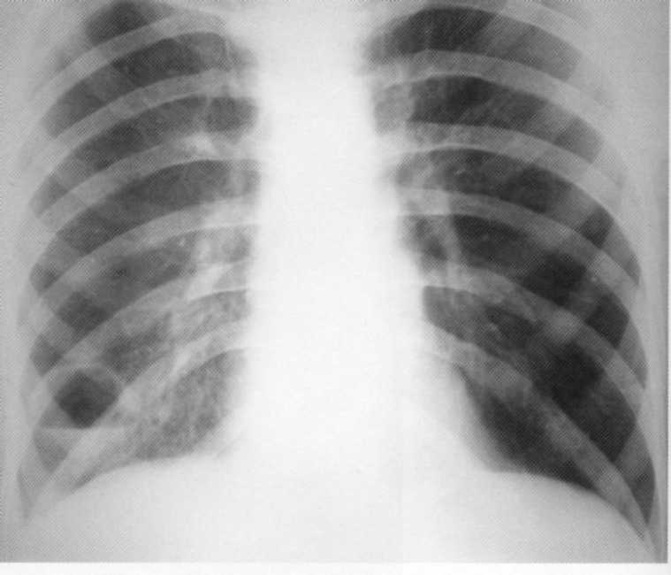 Верхушки легких тени. Поражение легких при туберкулезе рентген. Туберкулез рентген снимки очаговый правой легки. Рентген легких при болезнях. Очаговые тени в легких справа туберкулез.